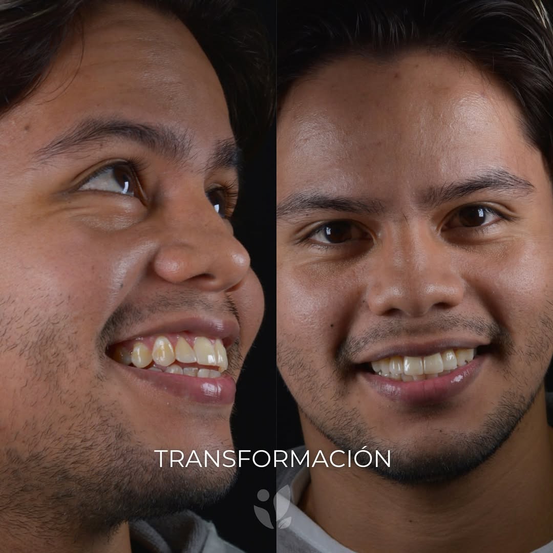 Esta increíble transformación es el resultado de un diseño de sonrisa funcional, donde combinamo