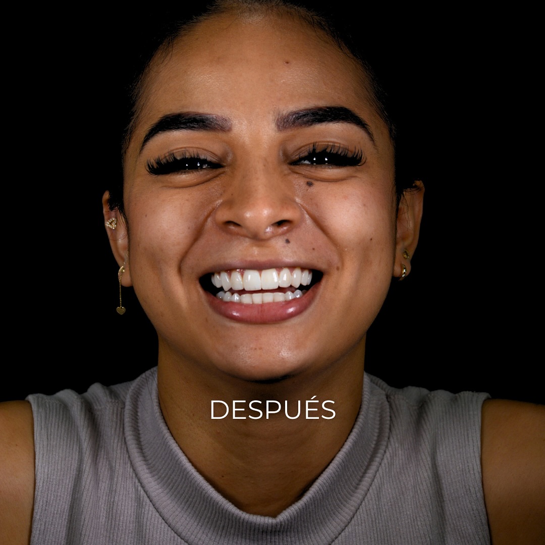 Qué tal este diseño de sonrisa funcional 🫶Amamos cambiar vidas, y aunque parezca raro, tu sonri